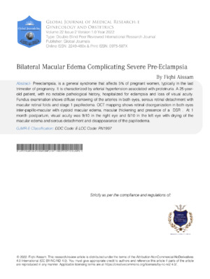 Bilateral Macular Edema research article for academic and clinical research on eye health and ophthalmology studies.
